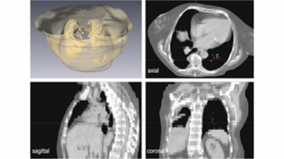 CT scans